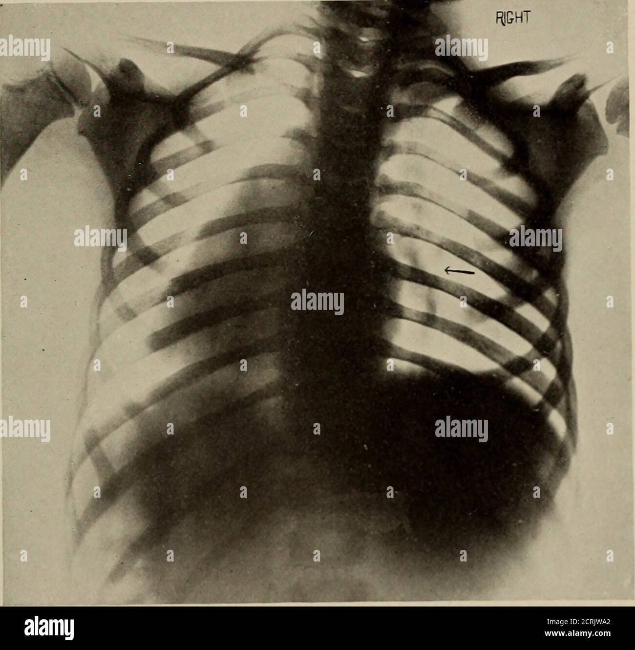 Transposed Organs . Living anatomy and pathology; . PLATE 109.ENLARGED BRONCHIAL NODES ...