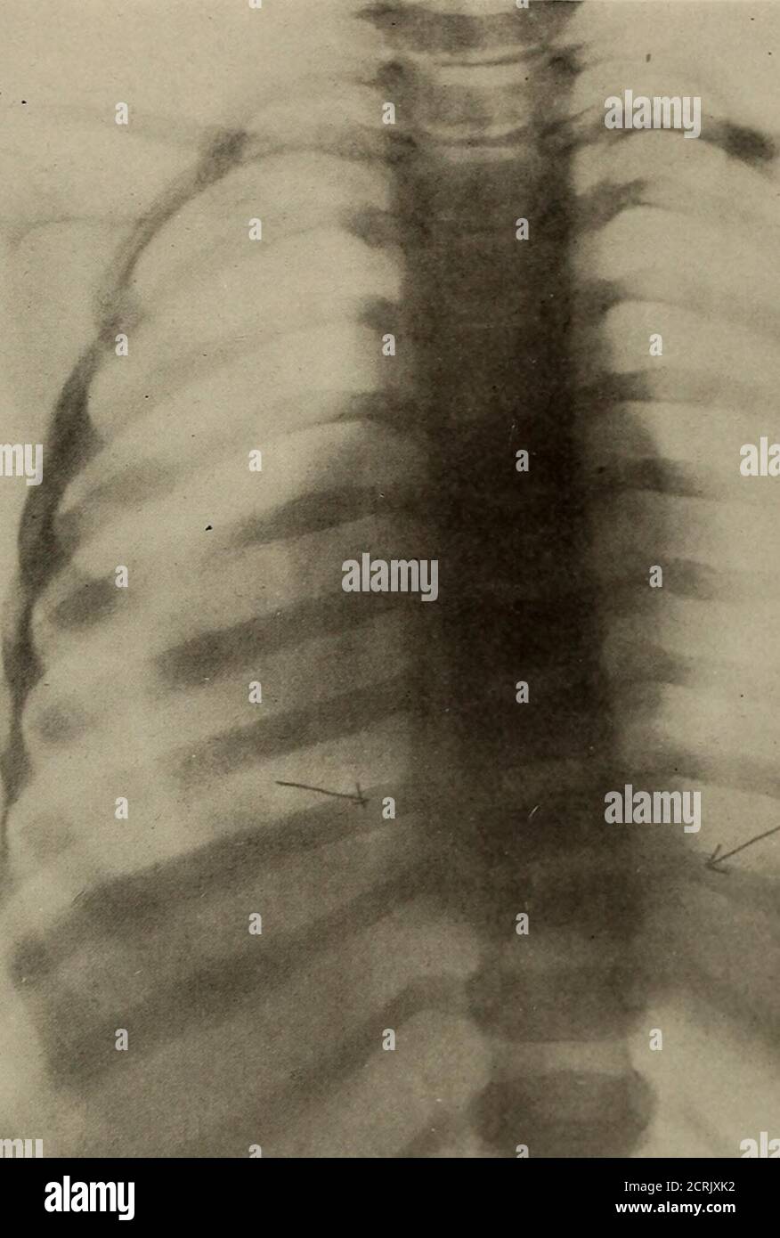 . Living anatomy and pathology; . v PLATE 104. TUBERCULAR ABSCESS OF THE SPINE. The arrows point towards the vertebras affected; namely,the ninth and tenth dorsal. PI.ATE 104. Stock Photo