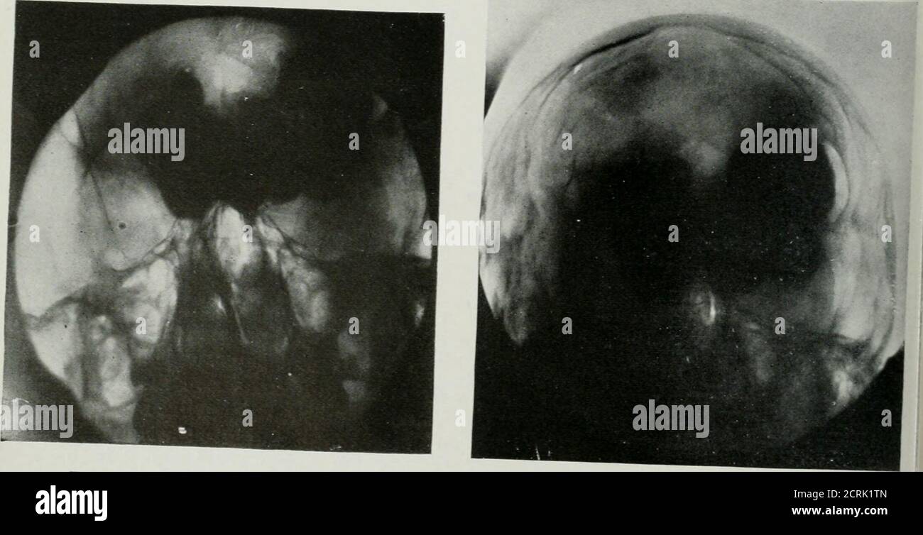 . The American journal of roentgenology, radium therapy and nuclear medicine . Fig. 3. Lateral View. July 31, 1915. Fig. 4. Front View. July 31, 191 915 Fig. 5. Front View. Jlly 5, 1916 Osteoma of the Frontal Sinuses 343 clthe forehead. The anterior plate of thefbntal bone was found detached and show-ig signs^of^necrosis. Upon removal, anir-igular ivory-like mass was found extend-m over the areas as indicated by the x-ra}*lates. The whole mass was removed, leav-:g the internal plate of the frontal bone[tact. The bone around the frontal sinusas found to be quite vascular and some- ward beyond t Stock Photo