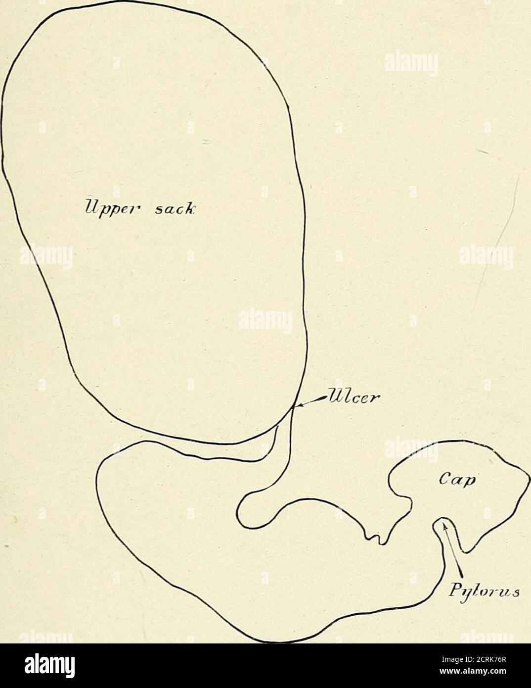. Roentgen interpretation; a manual for students and practitioners . Fig. 138.—Stomach sho-wing penetrating ulcer of lesser curvature. Patient standing. irregularities of carcinoma which vary according to the size, shapeand position of the tumor. These deformities are usually eitherannular or due to the presence of irregular masses invading thebarium mixture, leaving ragged holes or markings suggesting fingerprints. We may also have the local contractions due to an ulcerwith its associated spasm; or the extensive defects of lues, suggest- STOMACH 163 ing ulcer or carcinoma. Another deformity i Stock Photo