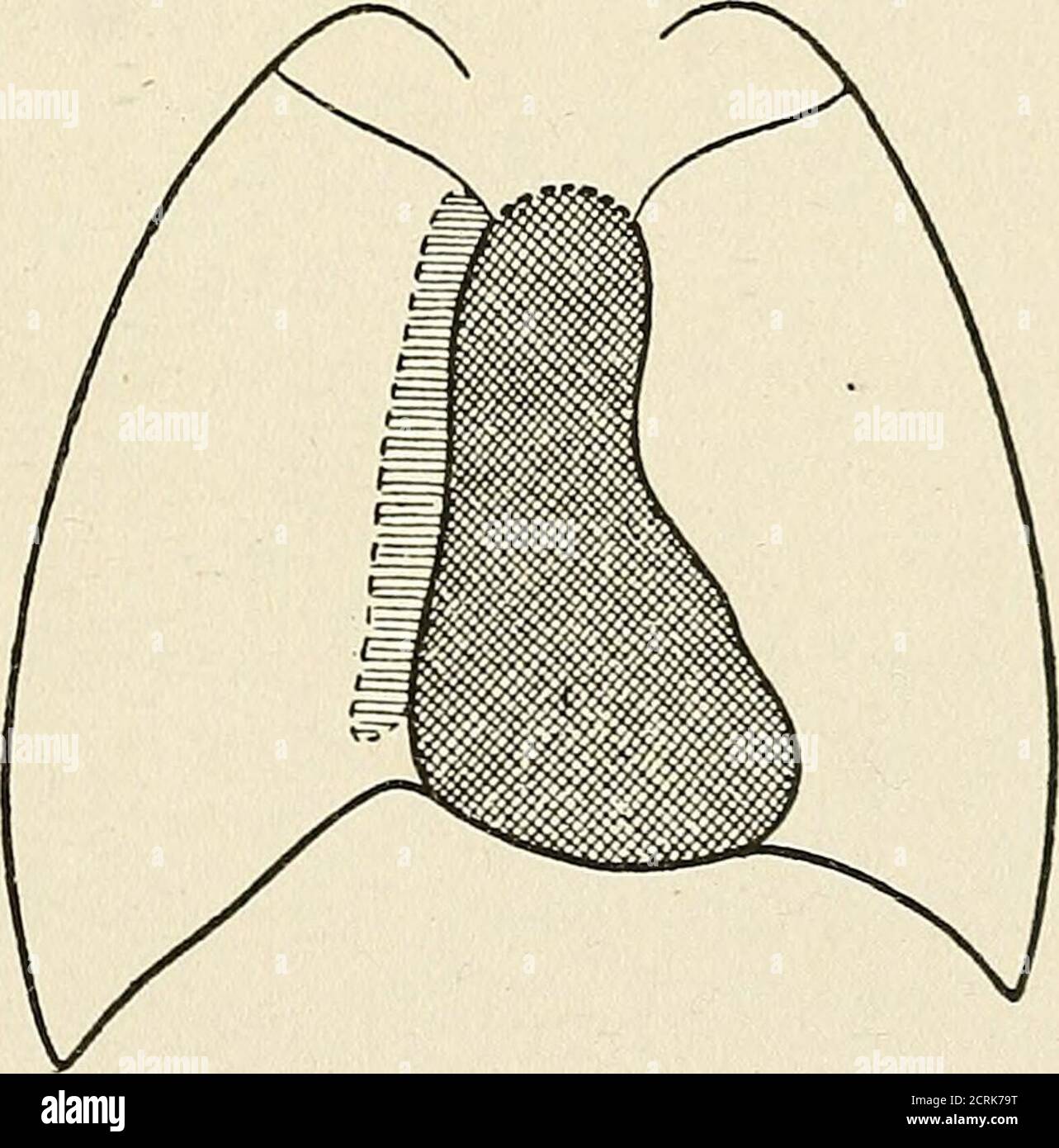 . Radio-diagnosis of pleuro-pulmonary affection . Fig. 16. ARTIFICIAL ...