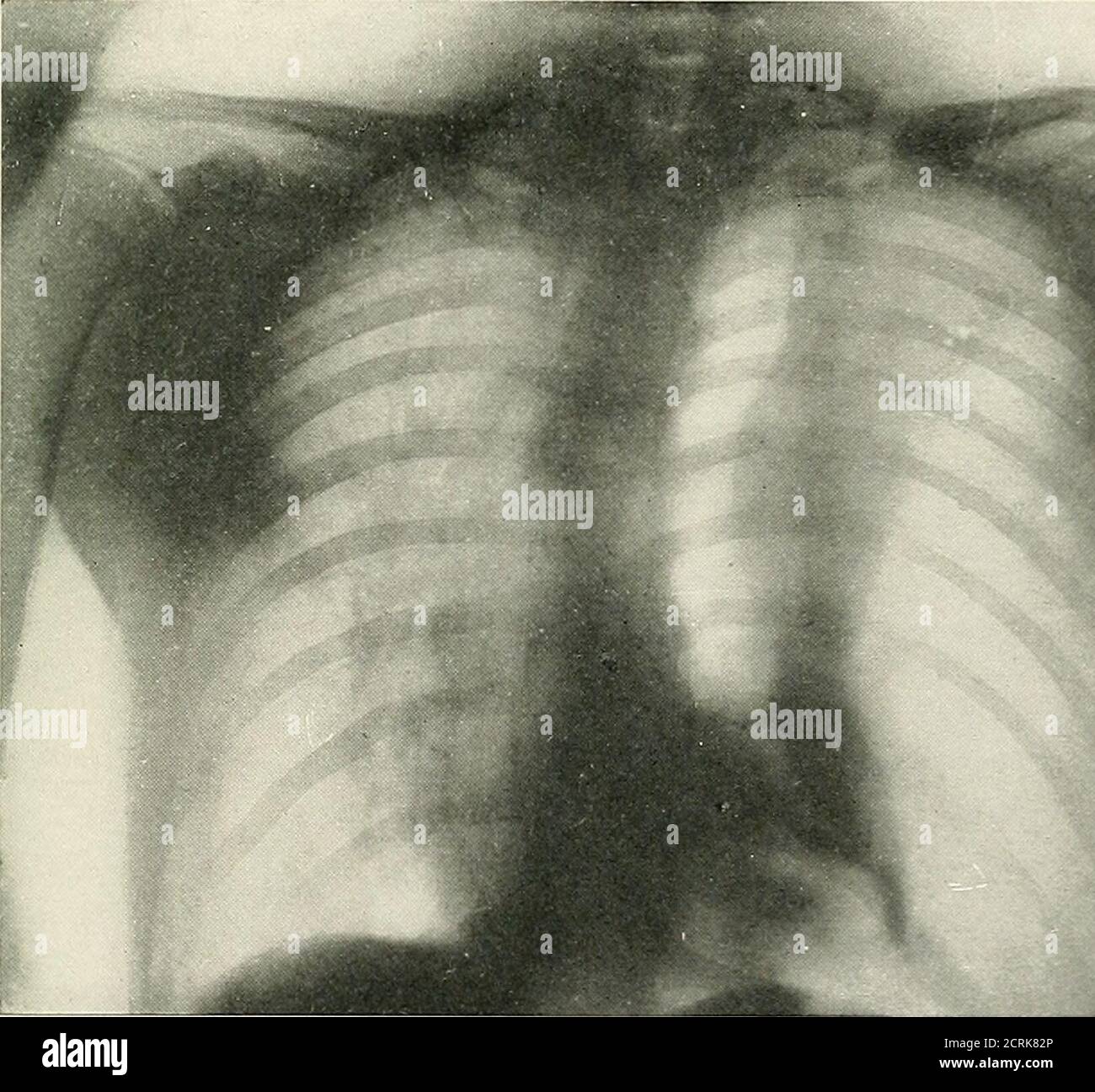 Radio-diagnosis of pleuro-pulmonary affection . Radiograph 10. ARTIFIC^IAL  PNEUMOTHORAX FOR TUBERCULOSISOF THE RIGHT LUNG Complete detachment of the  lung except in the extreme apex. Lung retractedtowards the hilus in  complete collapse.