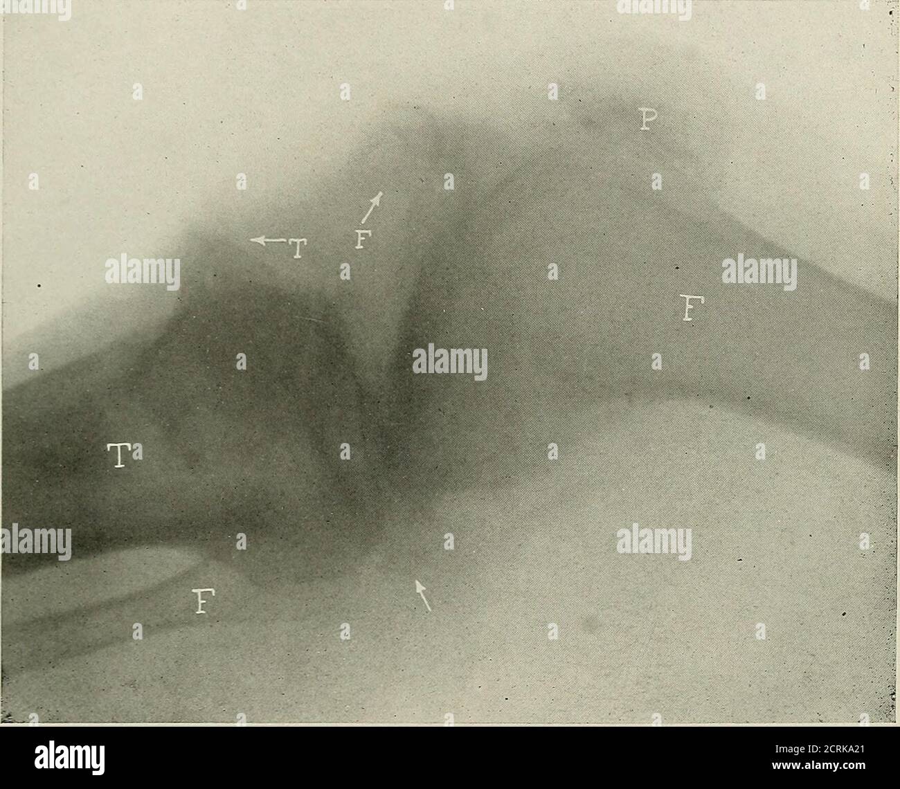 Tabes dorsalis hires stock photography and images Alamy