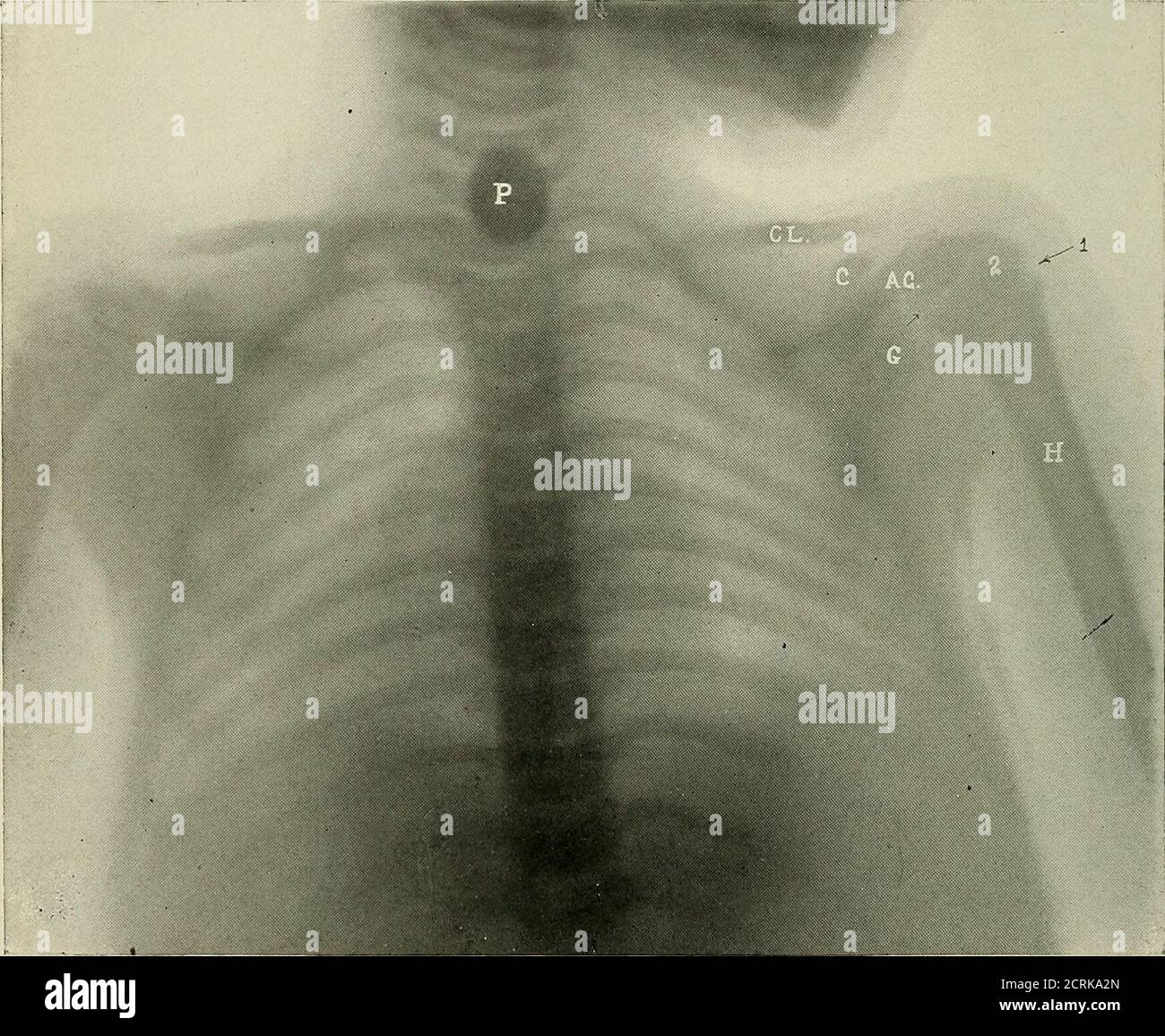 . Röntgen rays and electrotherapeutics with chapters on radium and