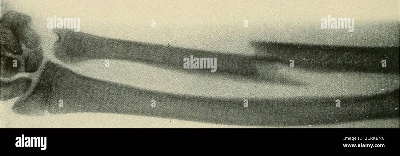 . Röntgen ray diagnosis and therapy . Fig. 153.—Fracture of Radial ...