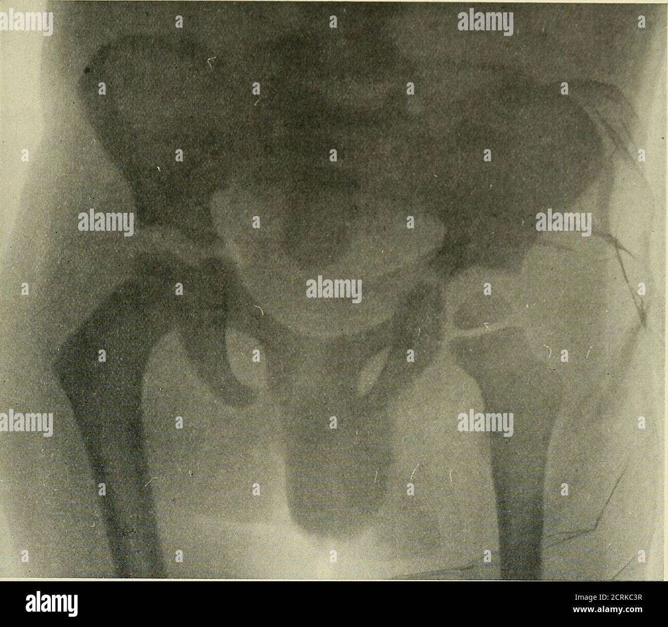 . Radiography, xray therapeutics and radium therapy . bercular disease of bones of hand