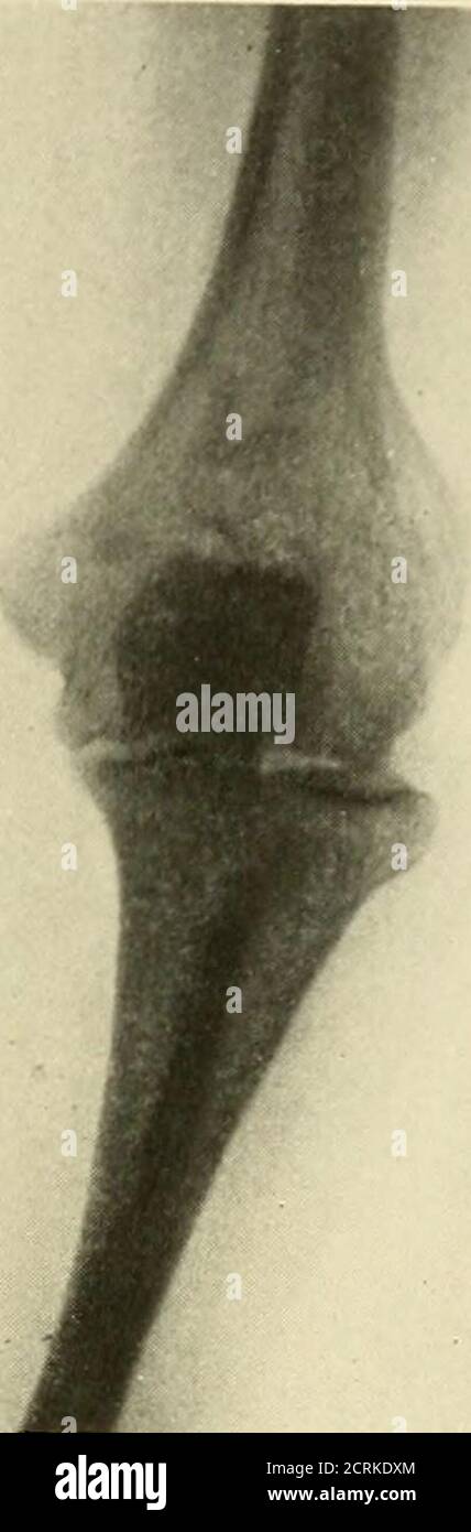 A practical treatise on fractures and dislocations . g lost its