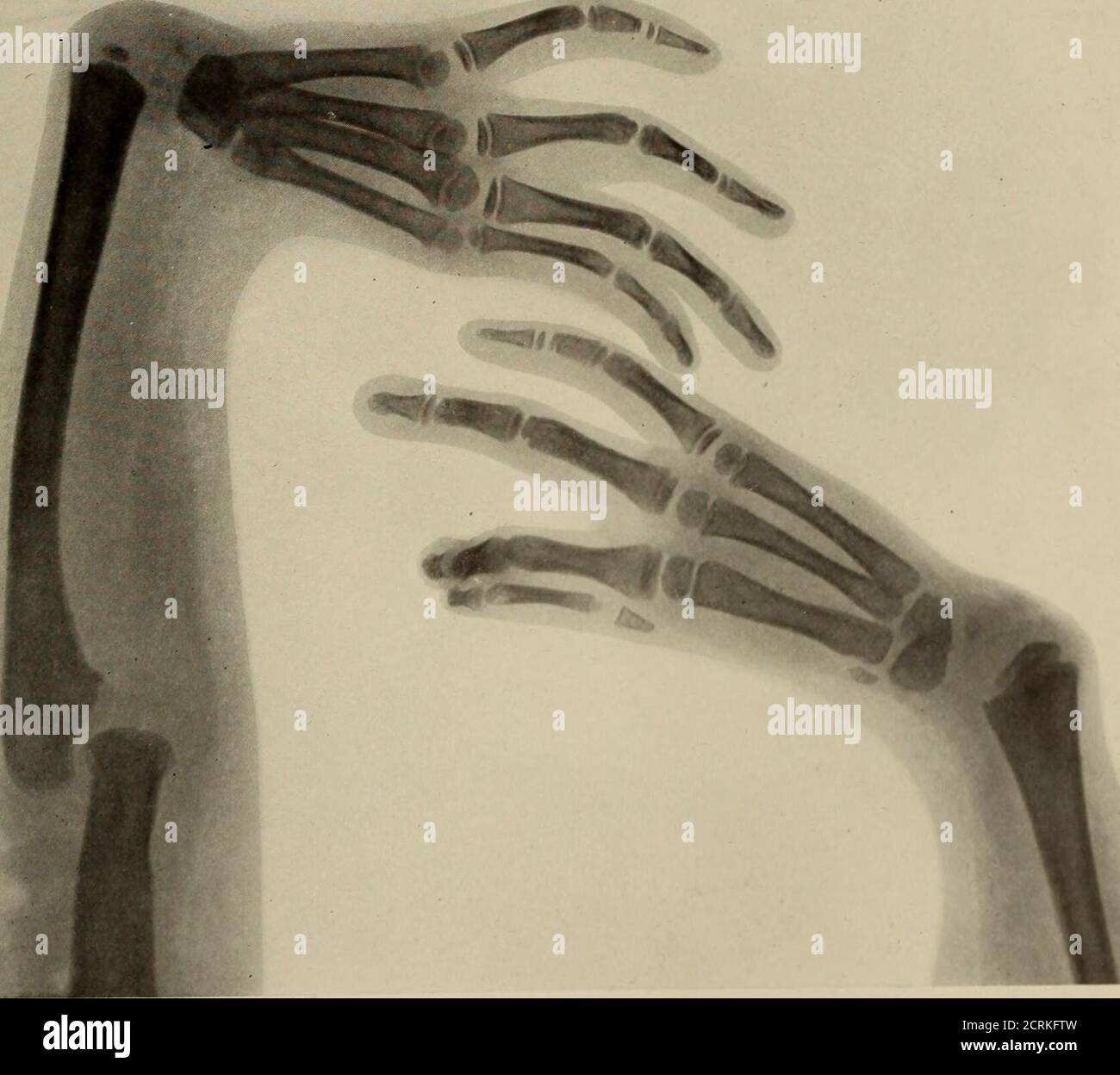 . Living anatomy and pathology; . FIG. 2.. PLATE 52.MALFORMATION OF THE ...