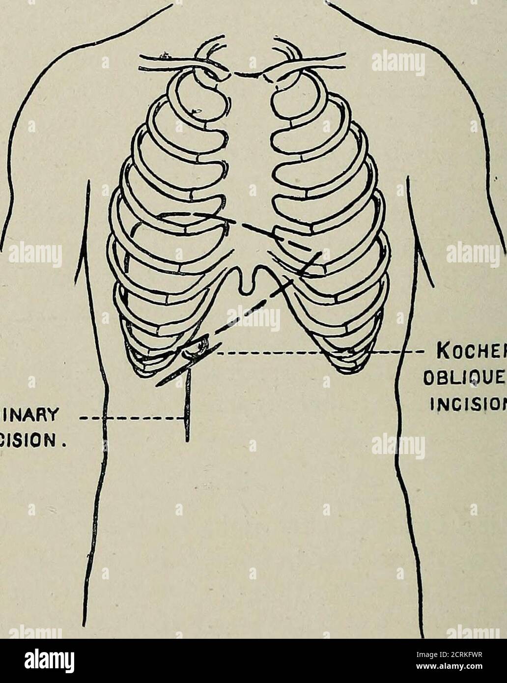 . Diseases of the gall-bladder and bile-ducts, including gall-stones . art; if there be no tumour, but an enlarged liver, theupper end of the incision will have to commence at thehepatic margin. If, however, as is so often the case, therebe neither tumour nor enlargement of the liver, the incisionwill be from the ninth costal cartilage, vertically downwardfor 3 inches. The aponeurosis in the semilunar line may be divided,but, as a rule, the fibres of the rectus may be separated, andthe anterior and posterior layers of the rectus sheath willthen be separately cut. If more room be required, it c Stock Photo