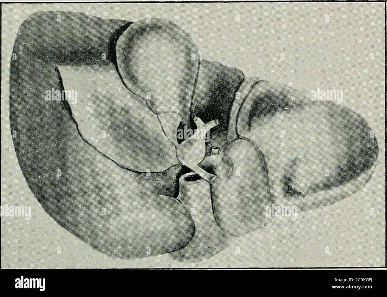 . Diseases of the gall-bladder and bile-ducts, including gall-stones . e for operation. When seen she was so ill that it was not considered safeto employ a general anaesthetic, especially as it was almostcertain she was now the subject of malignant disease as wellas gall-stones. The operation was done on July 20, cocaine being theonly anaesthetic used. The gall-bladder was aspirated, in-cised, and stitched to the parietes in the usual way, noattempt being made, on account of the weak condition ofthe patient, to exactly localize the obstruction. TUMOURS OF THE GALL-BLADDER AND BILE-DUCTS 147 No Stock Photo