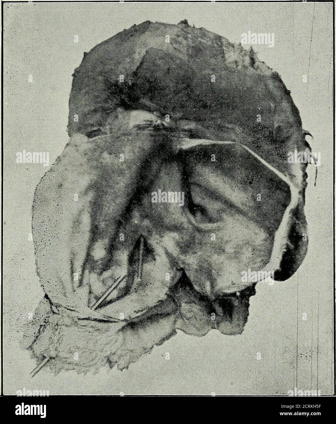 . Diseases of the gall-bladder and bile-ducts, including gall-stones . h the tube inserted into the cyst afterit had been stitched to the abdominal wall. As a result ofan attempt to connect the cyst with the bowel, peritonitis wasset up, and the patient succumbed. At the autopsy, the cystwas found to be firmly attached to the under surface of theliver, and seemed to be formed by enormous distension of thecommon and cystic ducts. The hepatic duct opened intothe cavity, but there was no communication between it andthe duodenum. Specimen No. 1,419, Guys Museum, shows a dilatation ofthe common bil Stock Photo