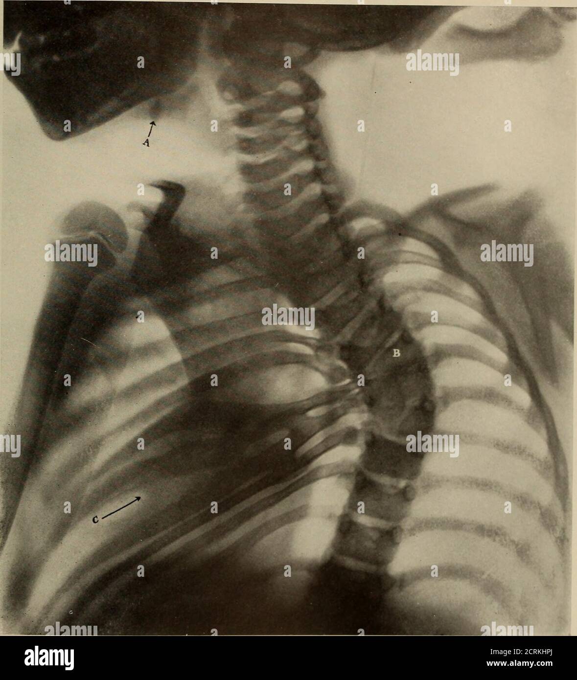 . Living anatomy and pathology; . / * PLATE 45.FUSION OF RIBS. MARKED