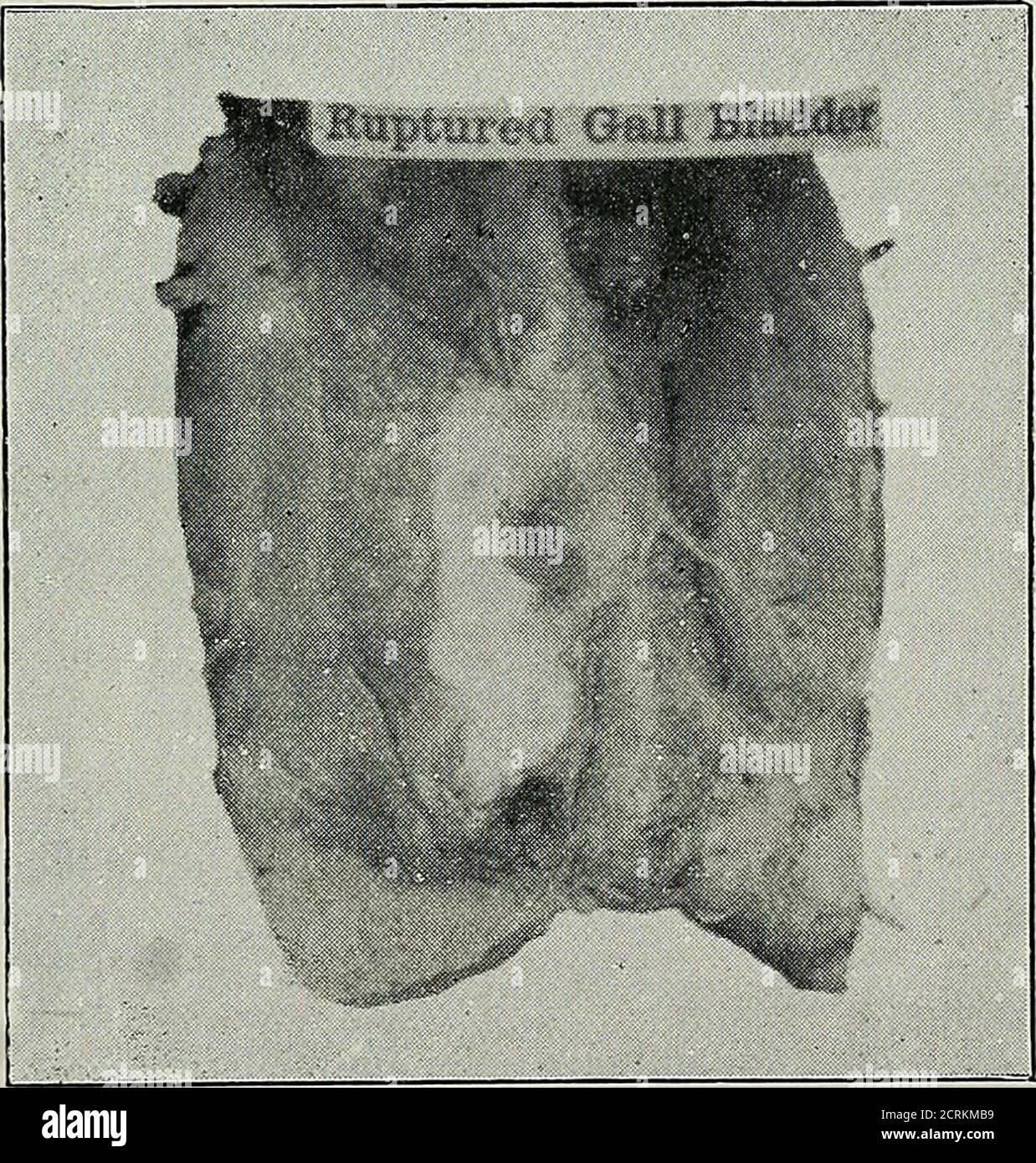 . Diseases of the gall-bladder and bile-ducts, including gall-stones . Fig. 18.(No. 2,267, St. Bartholomews Museum.). Fig. 19.—Rupture of Gall-bladder caused by a Fall, the Abdomenstriking.a Piece of Timber. Bile was extravasated, but the patient survived five weeks before death occurredfrom peritonitis. (No. 2,268, St. Bartholomews Museum.) jo DISEASES OF THE GALL-BLADDER AND BILE-DUCTS were distinct abdominal swelling, slight discoloration overthe region of the gall-bladder, and a temperature of ioi° F. ;there was no vomiting. On the 24th there was retention ofurine, and his bowels were move Stock Photo