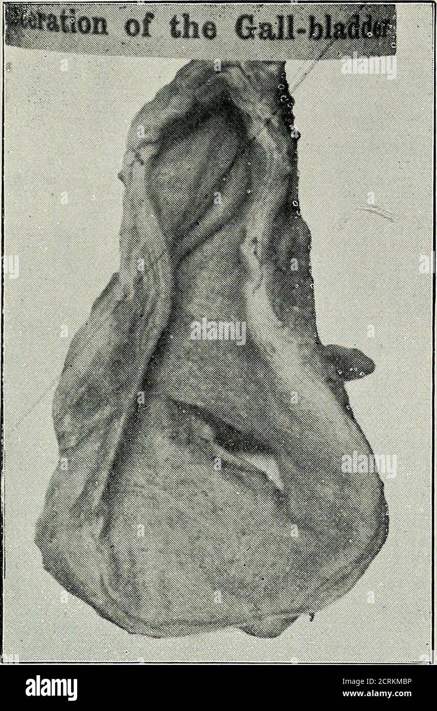 . Diseases of the gall-bladder and bile-ducts, including gall-stones . kicked in theabdomen, and died on the seventeenth day from peritonitis.The laceration in the gall-bladder measures f inch (Fig. 21). In all the cases where the history is appended, the fact ofthe long survival after so serious an accident is notable, andthe lesson is manifest, that operation would in each case havegiven good hopes of success. The following successful case* of drainage of the gall-bladder, apparently thirty days after rupture, by Dr. Martinof Blackburn, is of extreme interest, and is therefore given atlength Stock Photo