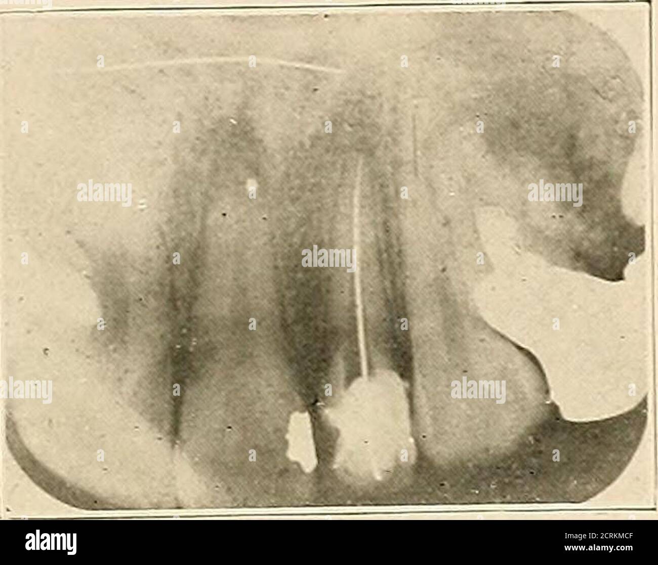 maxillary second premolar