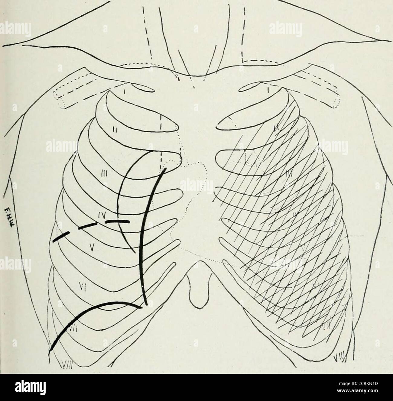 . The Roentgen rays in medicine and surgery as an aid in diagnosis and as a therapeutic agent; designed for the use of practitioners and students . Fk;. 131. Thomas R. March 12, 1897. Pleurisy with effusion. First X-ray examination withscreen. Whole of left chest dark; first and second ribs seen faintly; heart displaced to right. (Curone-third life size.) with diminished breathing and voice sounds; tactile fremitus muchdiminished ; in the left back the same signs, most marked from belowangle of scapula to base; at base, flatness by percussion; respiratorymurmur absent. PLEURISY WITH EFFUSION. Stock Photo