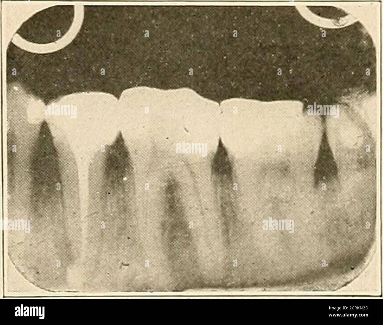 . Interpretation of dental & maxillary roentgenograms . Fig. 211.—A