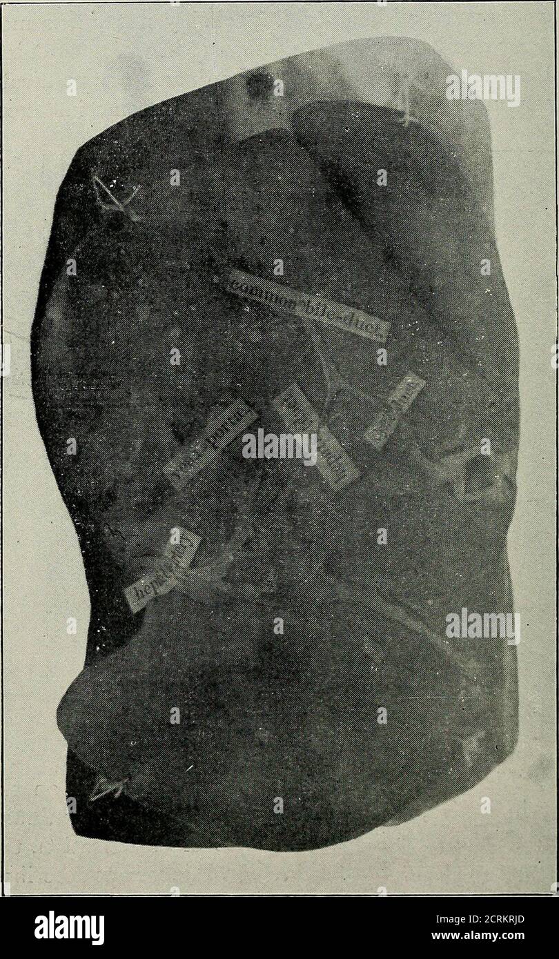 . Diseases of the gall-bladder and bile-ducts, including gall-stones . Fig. 1.(No. 1,390, Guys Museum. no doubt, this condition arises from contraction of an oldulcer, but in others, as in Case 55, the mucous membranebeing smooth and showing no evidence of cicatrization, thedeformity appears to be congenital. Dr. Pilcher has describeda case belonging to the latter category, and another hasrecently been published by Dr. H. C. Donald, of Paisley, inwhich the gall-bladder was found to be thickened and con-tracted, being firmly adherent to, and tucked up to, theunder surface of the liver. It was d Stock Photo