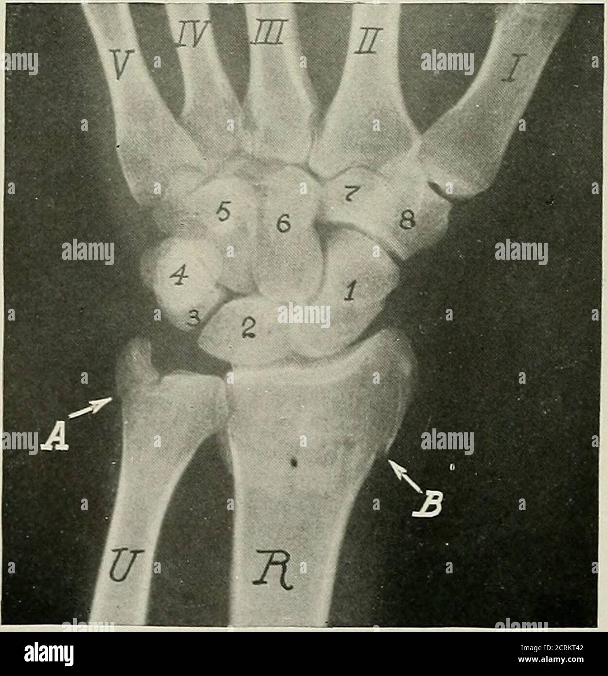 Styloid Process X Ray