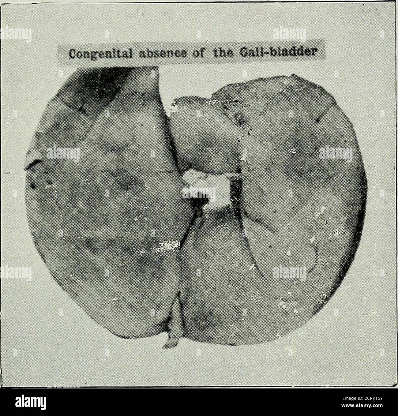 . Diseases of the gall-bladder and bile-ducts, including gall-stones . e been found dilated. Congenital Malformations.—There is apparently no part ofthe biliary apparatus, except the liver, which may not beabsent; while this is not to be wondered at in the case of thegall-bladder and cystic duct (as in specimen No. 1,390 inGuys Museum, in one specimen in St. Thomass, and in twoat Middlesex), since they are normally wanting in certainanimals, and are frequently obliterated by disease in thehuman subject; it affords serious food for thought, to findthat life has been possible for six months, whe Stock Photo