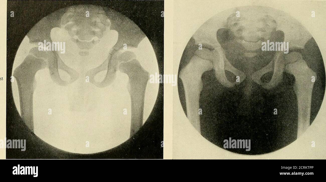 Epiphyses of the femur hi-res stock photography and images - Alamy