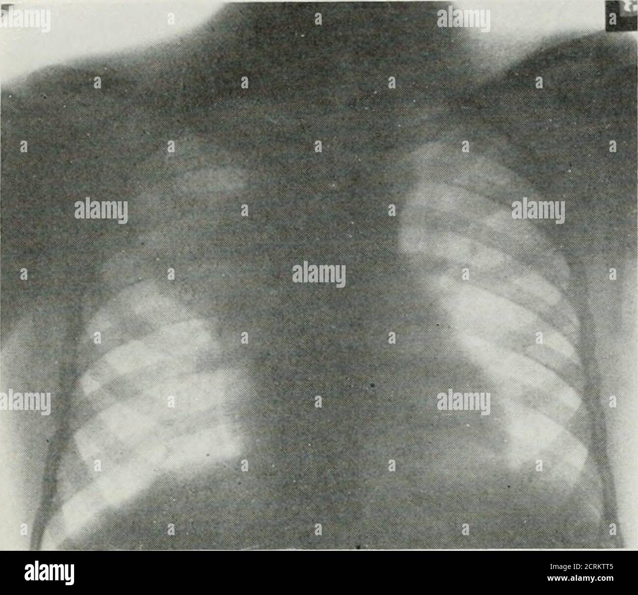 . The American journal of roentgenology, radium therapy and nuclear medicine . Fig. 4. AxECRYSM.Descending aorta. The lack of sharply defined edges indicates pulsation. to their proximity to large vessels, and itis only by a careful fluoroscopic study,the mass being viewed from differentangles, that it is possible to differentiatebetween the two conditions. Occasionally, Temiomata.—These resemble dermoidcysts in their location and general charac-teristics. They are usually flattened outagainst the anterior chest wall, and, accord-ing to Christian in Osiers Modern Medi- i84 Roentgenological Exa Stock Photo