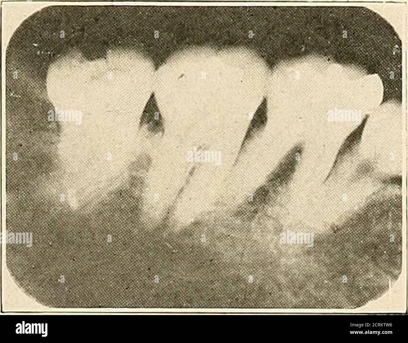 . Interpretation of dental & maxillary roentgenograms . Fig. 190. Fig ...