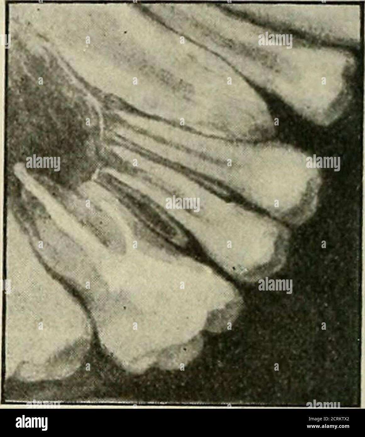 . Die Röntgentechnik : Lehrbuch für Ärzte und Studierende . Fig. 69. treten, ob hier in Wirklichkeit ein solcher Prozeß besteht, oder obeine in der Tiefe liegende alte Zahnwurzel zu der Affektion denAnlaß gibt. Das Röntgenverfahren entscheidet in diesem Falle mitPräzision die Sachlage, da es wohl stets möglich ist, Zahnwurzelrestevon gummösen oder kariösen Zerstörungen des Kieferknochens zuunterscheiden. Es muß indessen hervorgehoben werden, daß solche seit Jahrenim Kiefer steckende Zahnwurzeln eine Atrophie erleiden, ähnlichderjenigen, welche wir auch sonst an den Knochen zu beobachtengelernt Stock Photo