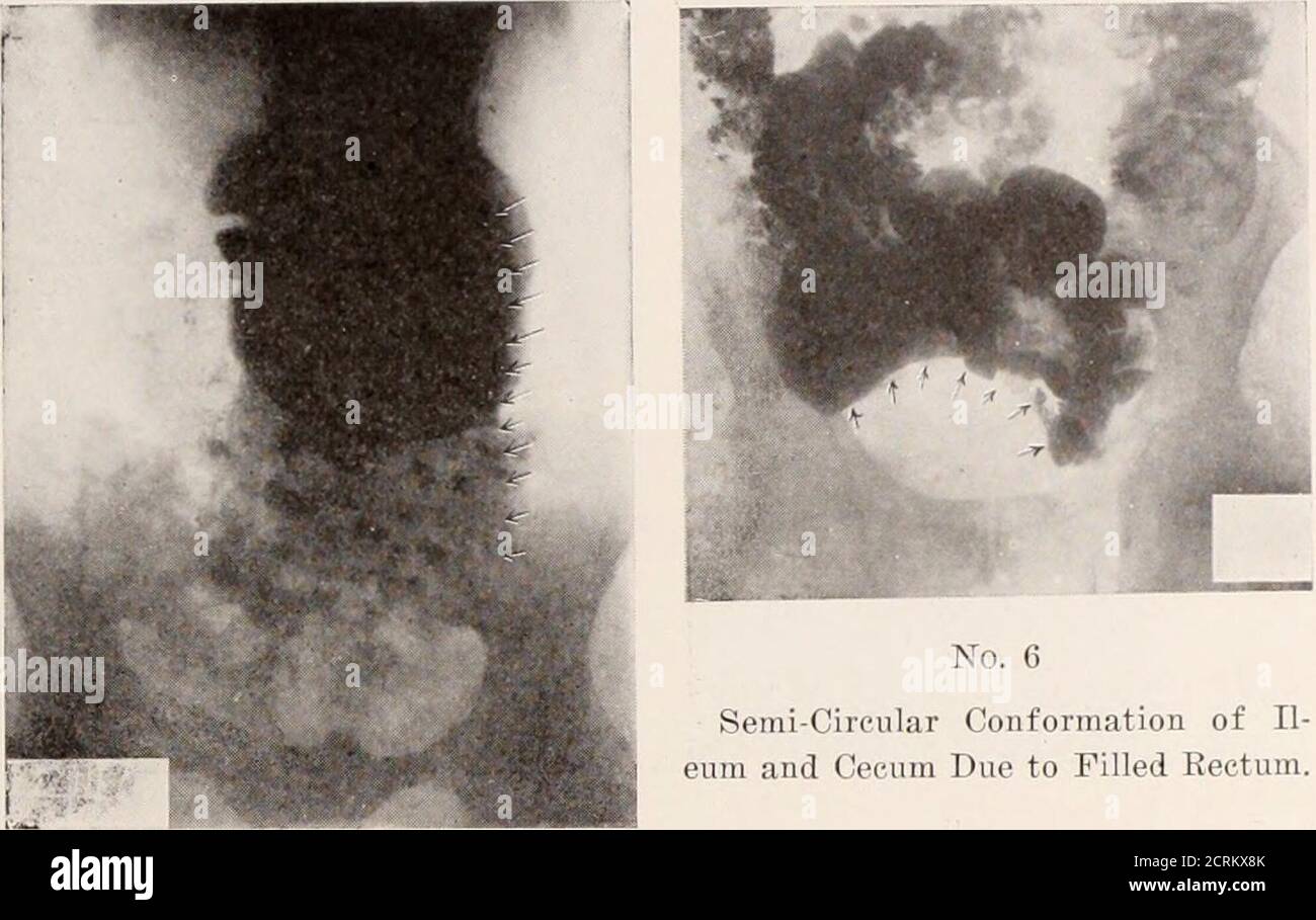 . Journal of roentgenology . No. 3 Filling Defect Due to Entrance of Na ...