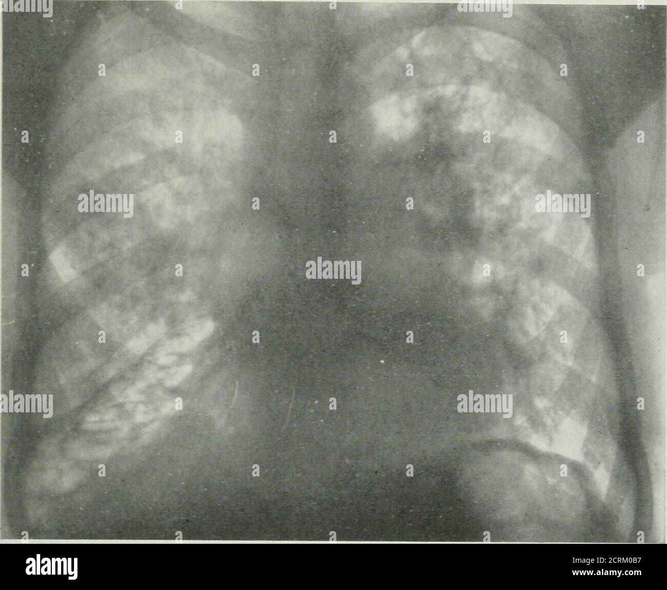Apices of lungs hi-res stock photography and images - Alamy