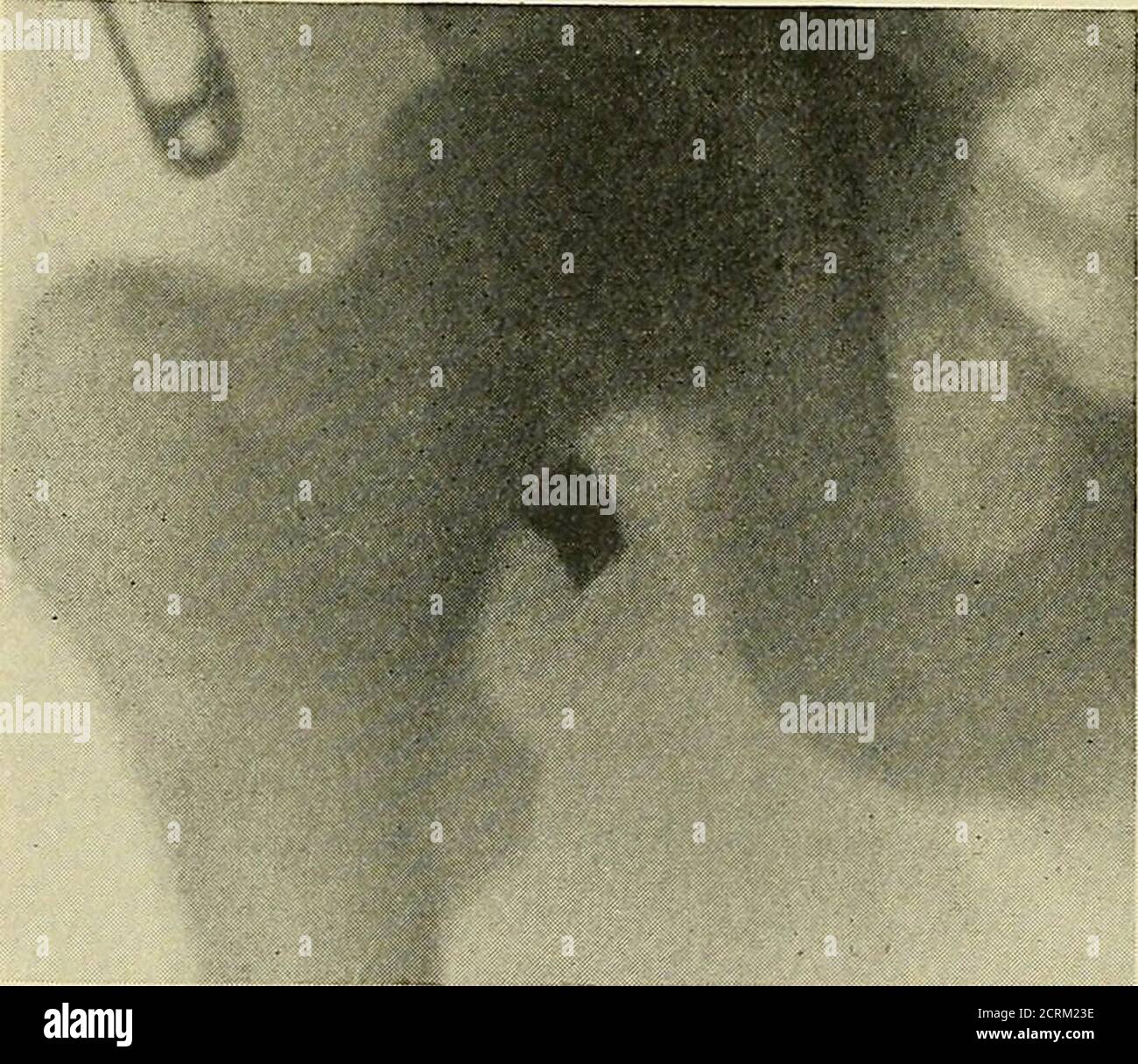 Shrapnel Torso . Radiography, x-ray therapeutics and radium therapy . Fig. 98 ...