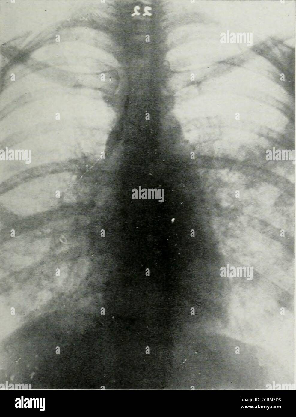 Dissected lung hi-res stock photography and images - Alamy