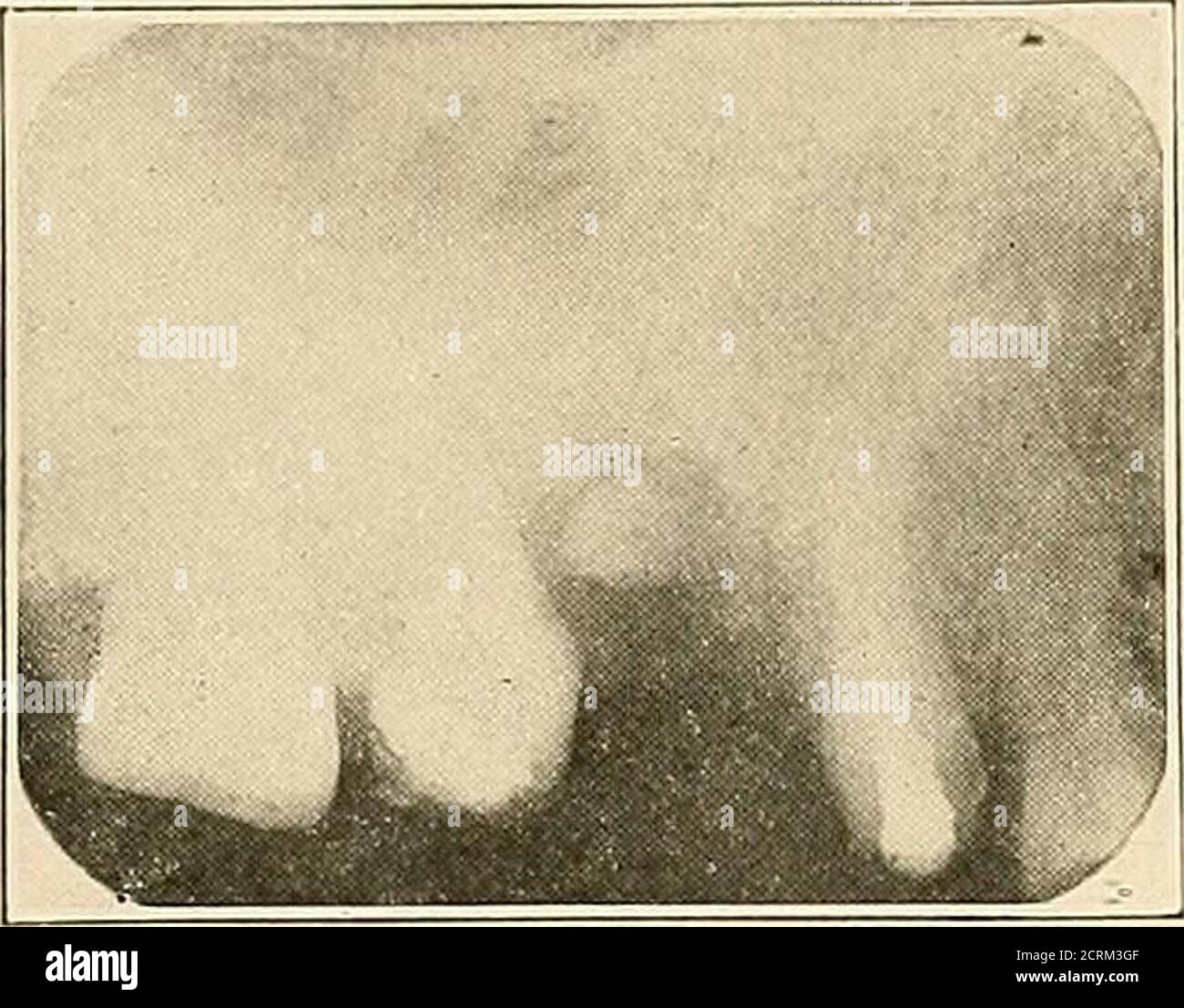 Interpretation Of Dental Maxillary Roentgenograms Fig 140 Fig Hi Fig 140 Condition About Premolars Is Ill Defined Owing To Overexposure Offilm First Molar Crowned Imperfeel Root Idlings Apex Of Lingual Runt