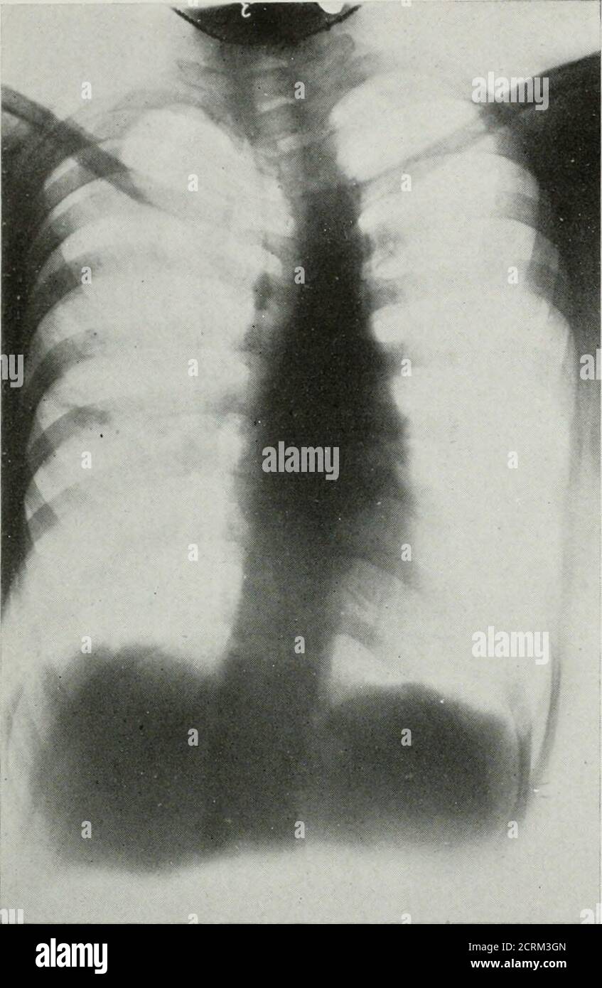 . The American journal of roentgenology, radium therapy and nuclear medicine . FiG. 2. SHOv^xG In-erted Comma. Asymmetry of chest; calcification of hilus clusters;remains of left pleural effusion. 126 Inverted Comma Sign. Fig. 3. Showing Inverted Comma. Upper dorsal scoliosis to left leaving calcified commain bold relief. No other pulmonary focus of calcifica-tion. culosis. Known syphilis was present inbut 2 out of 52 cases and a negativeWassermann was present in 8. It is obvi-ously not a sign of pulmonary lues. Pre-vious pneumonia was present in 19 percent. Pulmonary infection other thantub Stock Photo