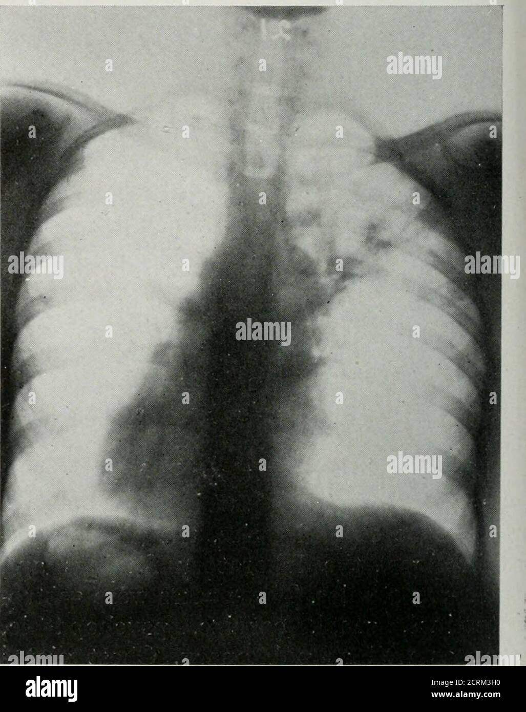 Walnut On Radiograph . The American journal of roentgenology, radium therapy and nuclear ...
