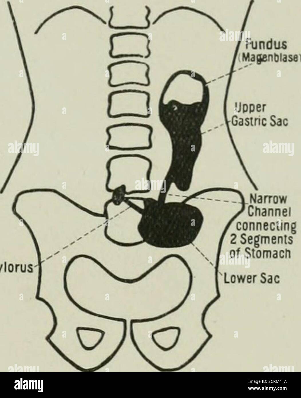 Radiography and radio therapeutics Pylorus Fig. 298. Hour glass contraction of the stomach. a Soon after ingestion of food. h One hour after ingestion. on the relationship of gastric ulcer to intermit...