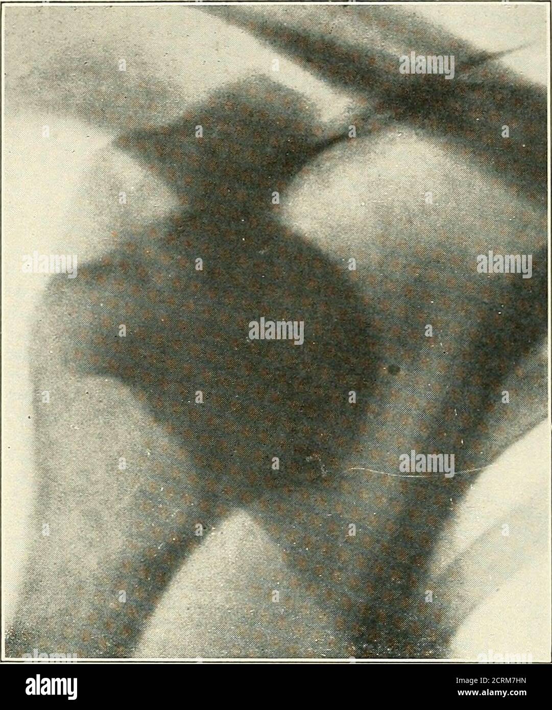 . Roentgen interpretation; a manual for students and practitioners . Fig. 22.—Double congenital dislocation of the hip. DISLOCATIONS. Dislocations of the spine are usually accompanied by fracture.They are most common in the cervical region. The first cervicalvertebra may be displaced backward on the second with fractureof the odontoid or, more rarely, rotated upon the second withoutfracture of the odontoid. The most frequent injury is a forwarddisplacement of the upper cervical vertebrae upon the ones belowin the region of the third to the seventh. 46 FRACTURES AND DISLOCATIONS. u,. --■;.- ni Stock Photo