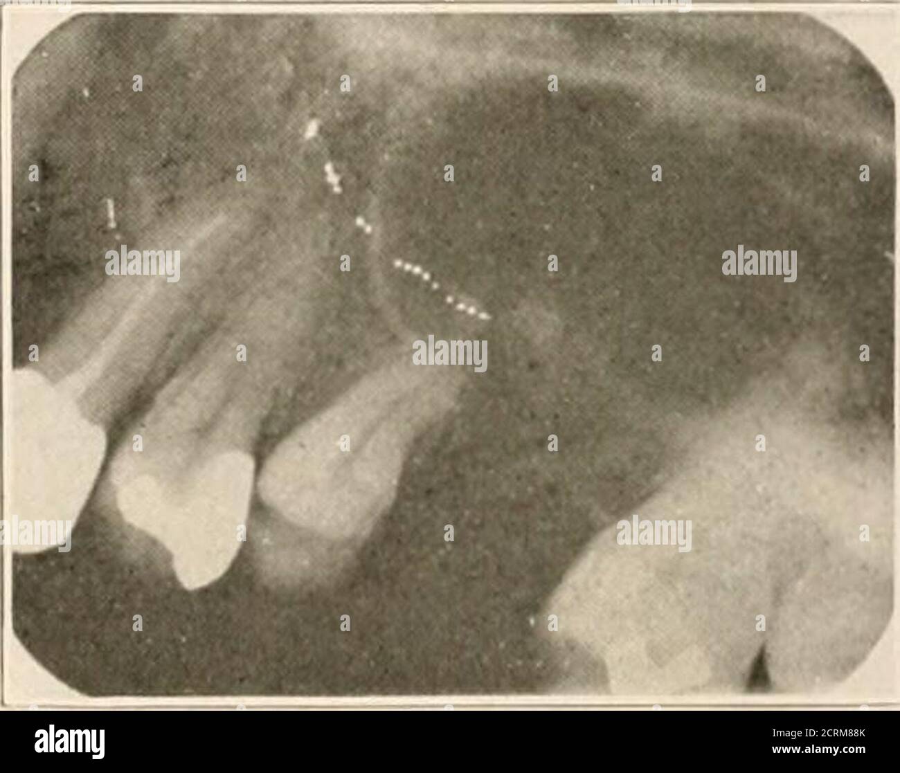 Periapical granuloma hires stock photography and images Alamy