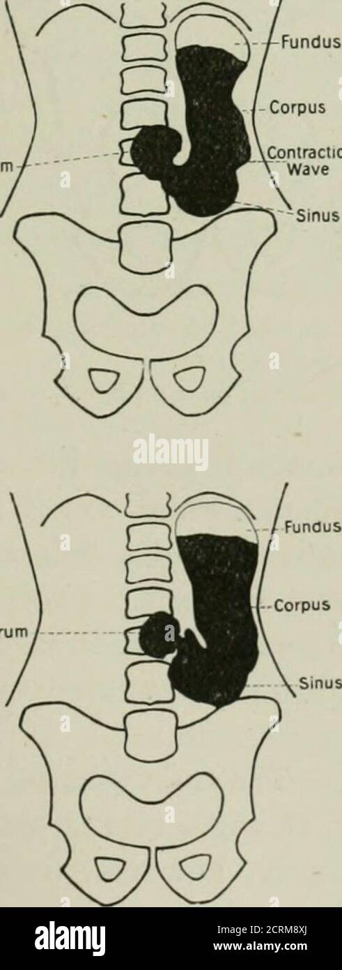  Radiography And Radio therapeutics Hypertonic Orthotonic Hypotonic Atonic Dilated Atonic 