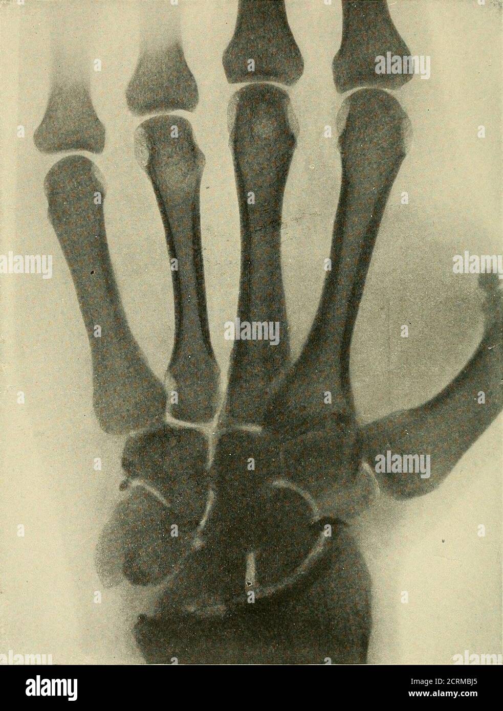 . Röntgen ray diagnosis and therapy . Fig. 15.—Fracture of Lower End of ...