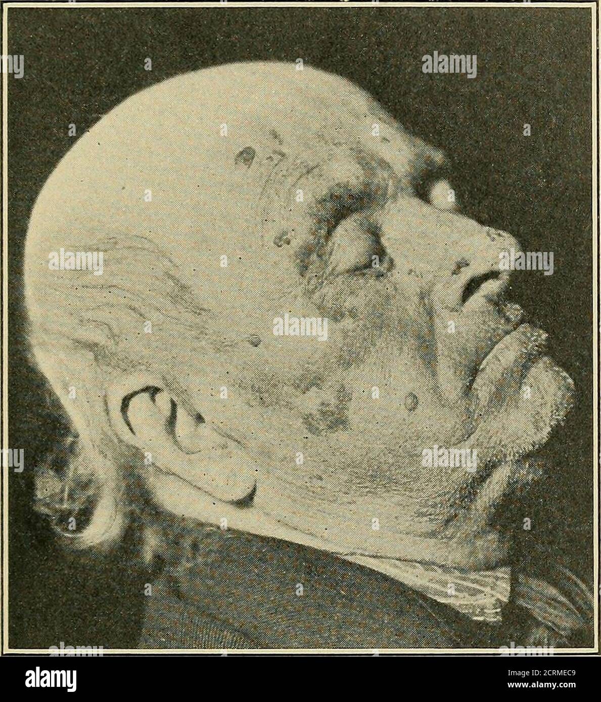 . Radiotherapy and phototherapy : including radium and high-frequency currents, their medical and surgical applications in diagnosis and treatment ; for students and practitioners . m an epithelioma began onthe tip of the nose about nine years before coming undermy care in February, 1902 (Fig. 55). This lesion had gradually extended until it occupiedthe region of the inner canthus and the eyelids to such anextent that surgical operation seemed to me out of thequestion. Besides this there are scattered over the foreheadand cheeks numerous flat, wart-like lesions of disseminatedepithelioma and l Stock Photo