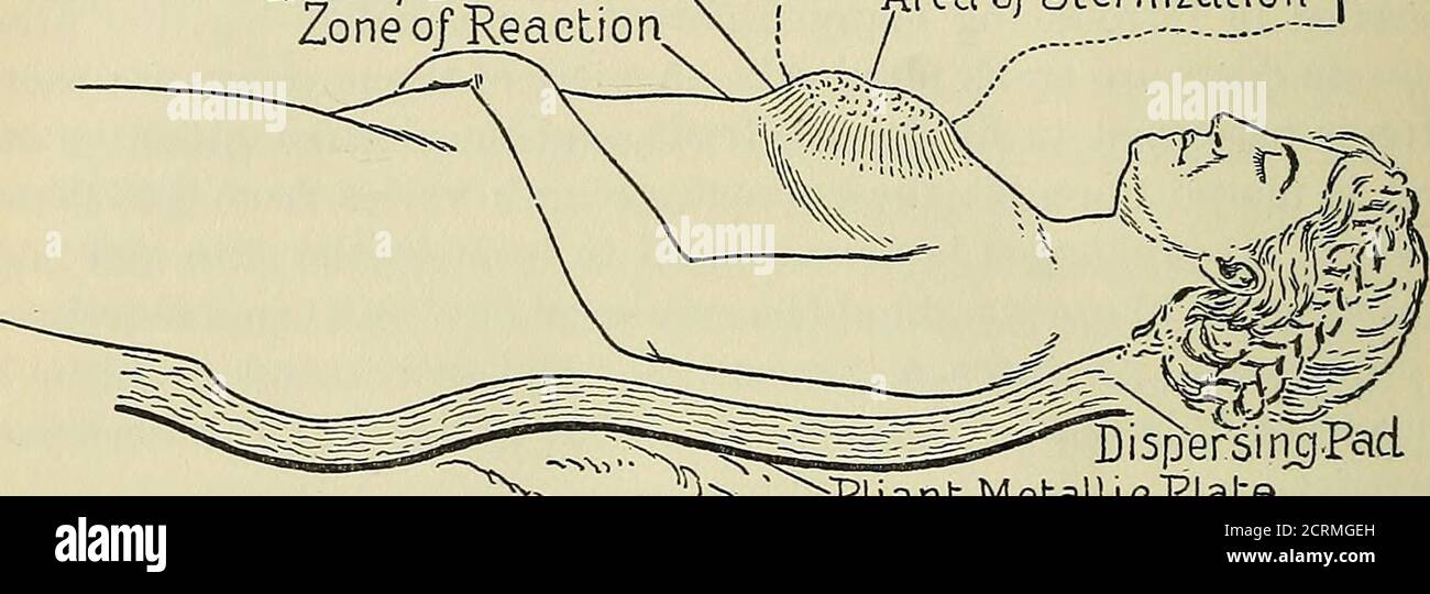 . Röntgen rays and electro-therapeutics : with chapters on radium and phototherapy . d in the one treatment binding post of the meter. They should belaid aside separately in a tray in such manner that the wires will not 1 Medical Times and Gazette, February 12 and June 25,1859.2 From Conservative Gynecology and Electro-Therapeutics, by Massey, p. 226. 47 48 ELECTEO-THERAPEUTICS. tangle when they are brought into use. Several of the electrodes may beslightly curved on the flat for greater ease of insertion in a slantingmanner. The patient having been anaesthetized, the electrodes are amalga-mat Stock Photo