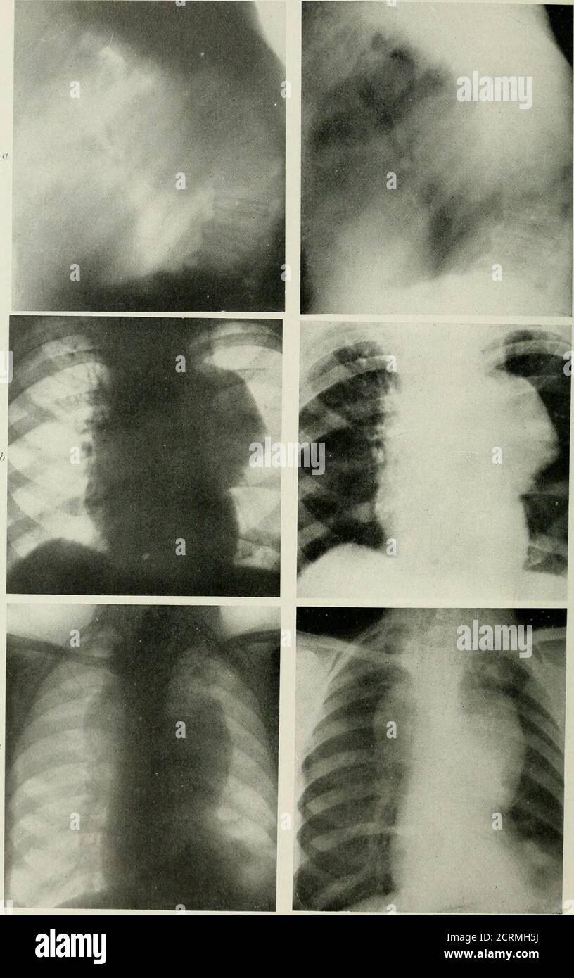 Axillw Calcified aorta hi-res stock photography and images - Alamy