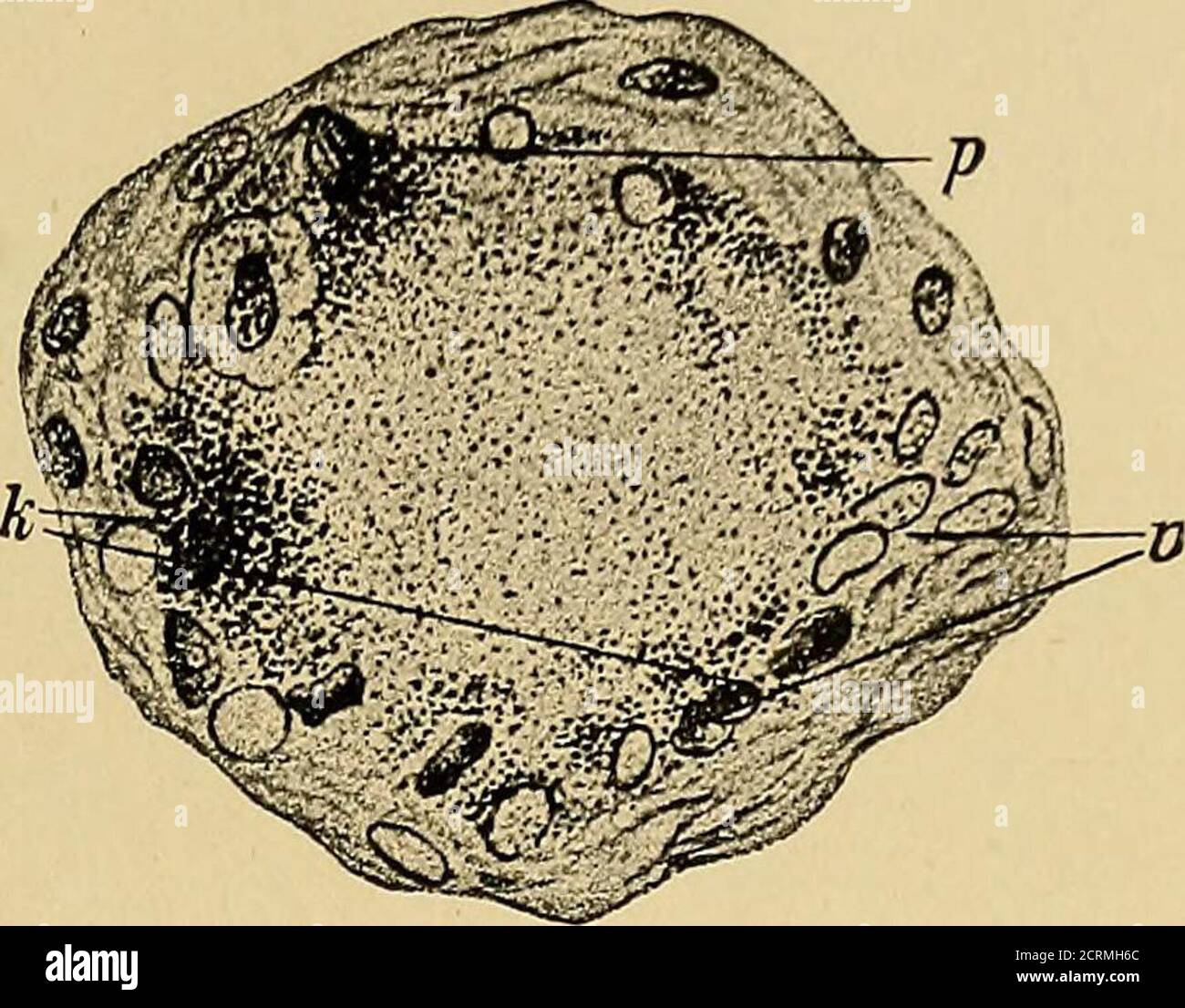 Ulcus Rodems Ulcus rodens hi-res stock photography and images - Alamy