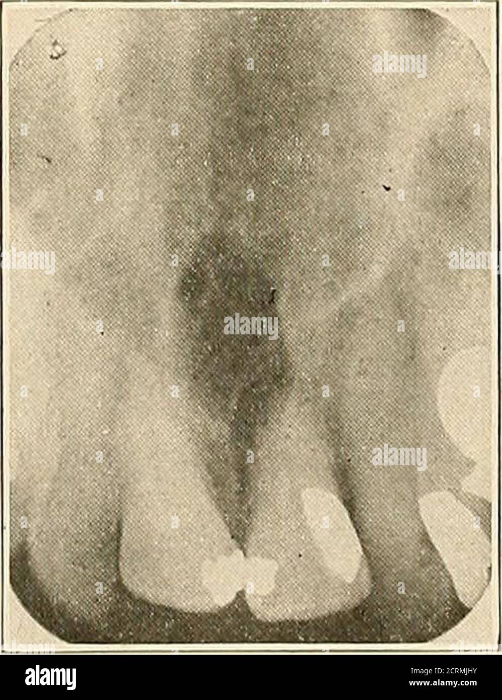 . Interpretation of dental & maxillary roentgenograms . Fig. 40. Fig ...