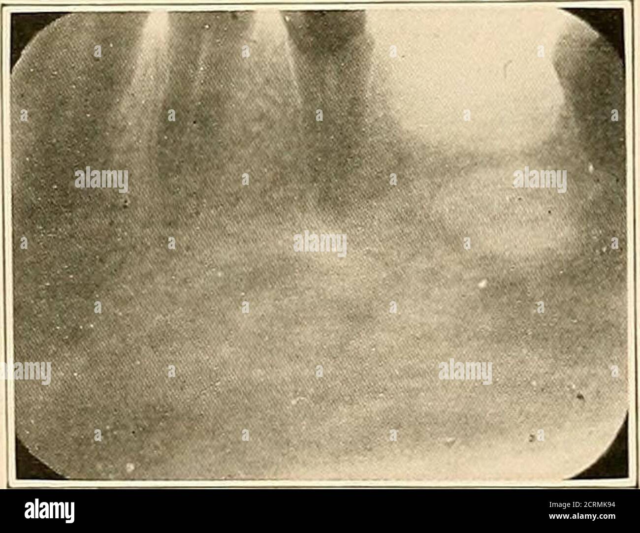 Abscessed High Resolution Stock Photography and Images - Alamy