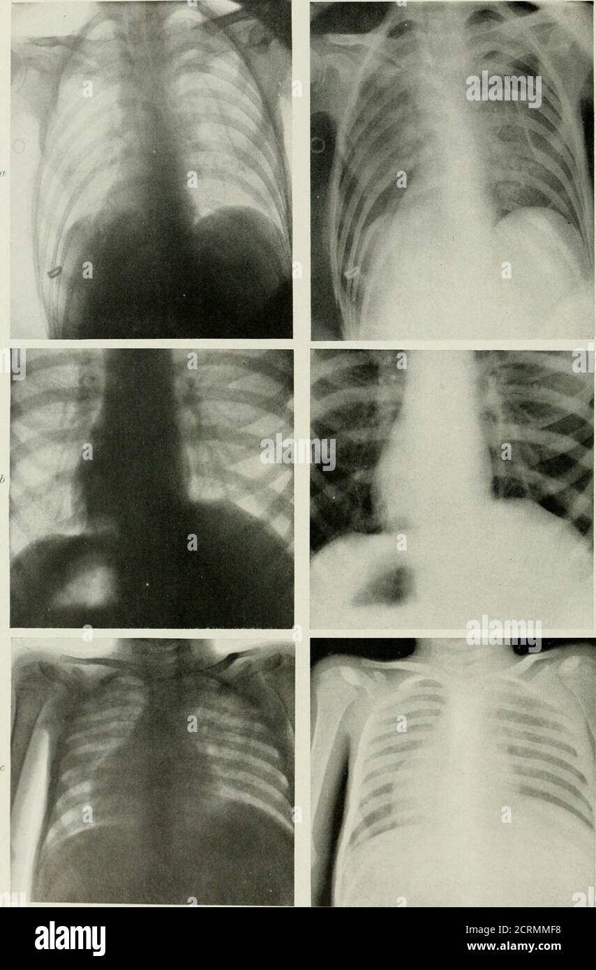 . Radiography and radio-therapeutics . PLATE LI I.—Radiograms showing Pulmonary Tuberculosis. a, Right apex showing advanced consolidation ; left apex involved but disease not so ad-vanced ; roots of lung botli involved but more so on right. b, Left side of chest extensively involved ; both apices are involved ; heart small and vertical. These two cases are both affected by active tuberciilosis. c, Healed tuberculosis of long standing ; both apices show signs of involvement ; roots oflungs show evidence of calcified glands. Patient had no active symptoms.. IJ^ATE LI 11.—KADlOCiKAM.S SHOWINi; P Stock Photo