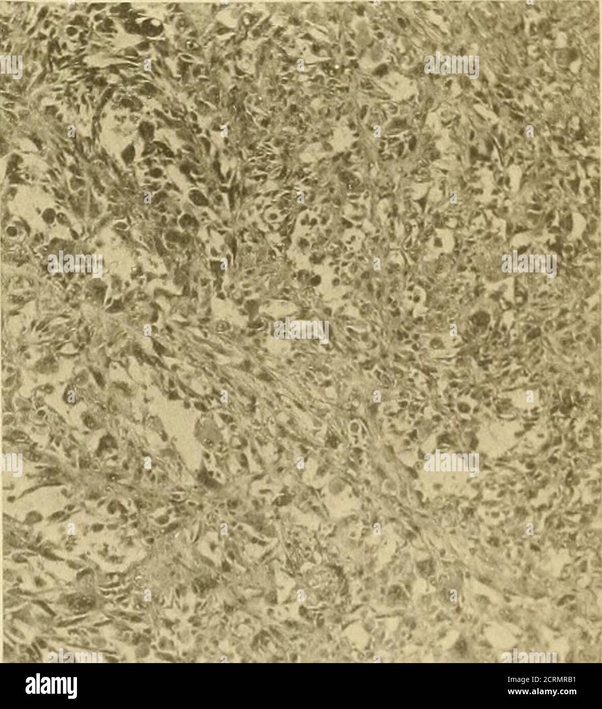 . The surgical treatment of X-ray carcinoma and other severe X-ray lesions, based upon an analysis of forty-seven cases . 22 ■^0^^^^. i!^^^, •^ 21 C. A. Porter. X ray lesions. THE PATHOLOGICAL HISTOLOGY OF CHRONIC X-RAY DER-MATITIS AND EARLY X-RAY CARCINOMA.* S. B. WOLBACH, M.D. {^Director of the Pathological Laboratory, Montreal General Hospital, Montreal.^ The development of multiple carcinomata in the skin ofpatients and operators who have suffered repeated injuriesfrom exposures to the X-rays has occurred so many timesthat the causal relationship has been generally accepted in allcountries Stock Photo