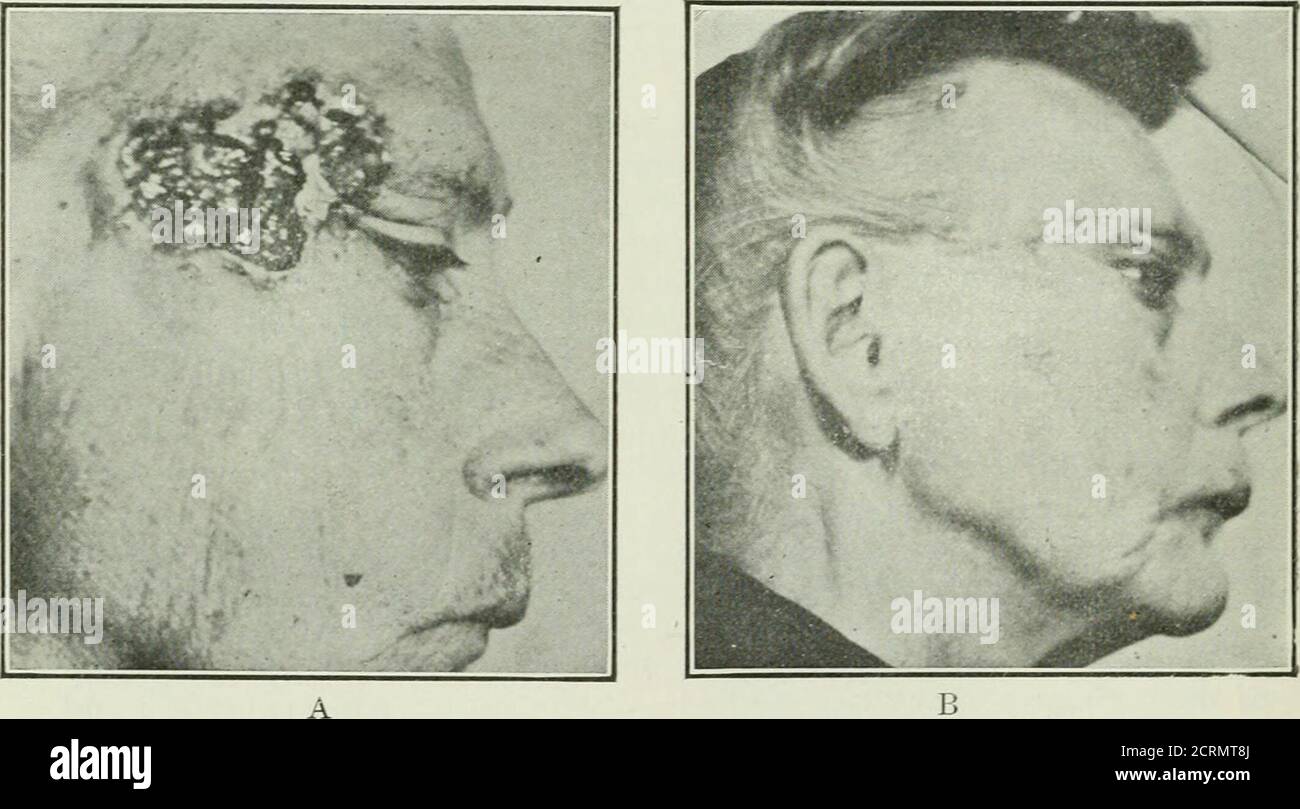 . Radium . Fig. 14.—A. epitlielioma involving the lower eyelid and inner canthus. Referred by Dr. P. M. K. Schwenk. Philadelphia. B. result of one desiccation treatment. Xote good cosmetic result with no contracted cicatrix.. Fig. 15.—A, basal cell epithelioma adherent to the bone, of 20 years duration.Referred by Dr. Wm. P. Hearn, Philadelphia. B, result of one electrocoagulationtreatment. Patient died one year later of pneumonia but without recurrence of the epithelioma. cation for radium is the same in either case, for no chances should betaken. If degenerated in the parenchyma, the glands Stock Photo