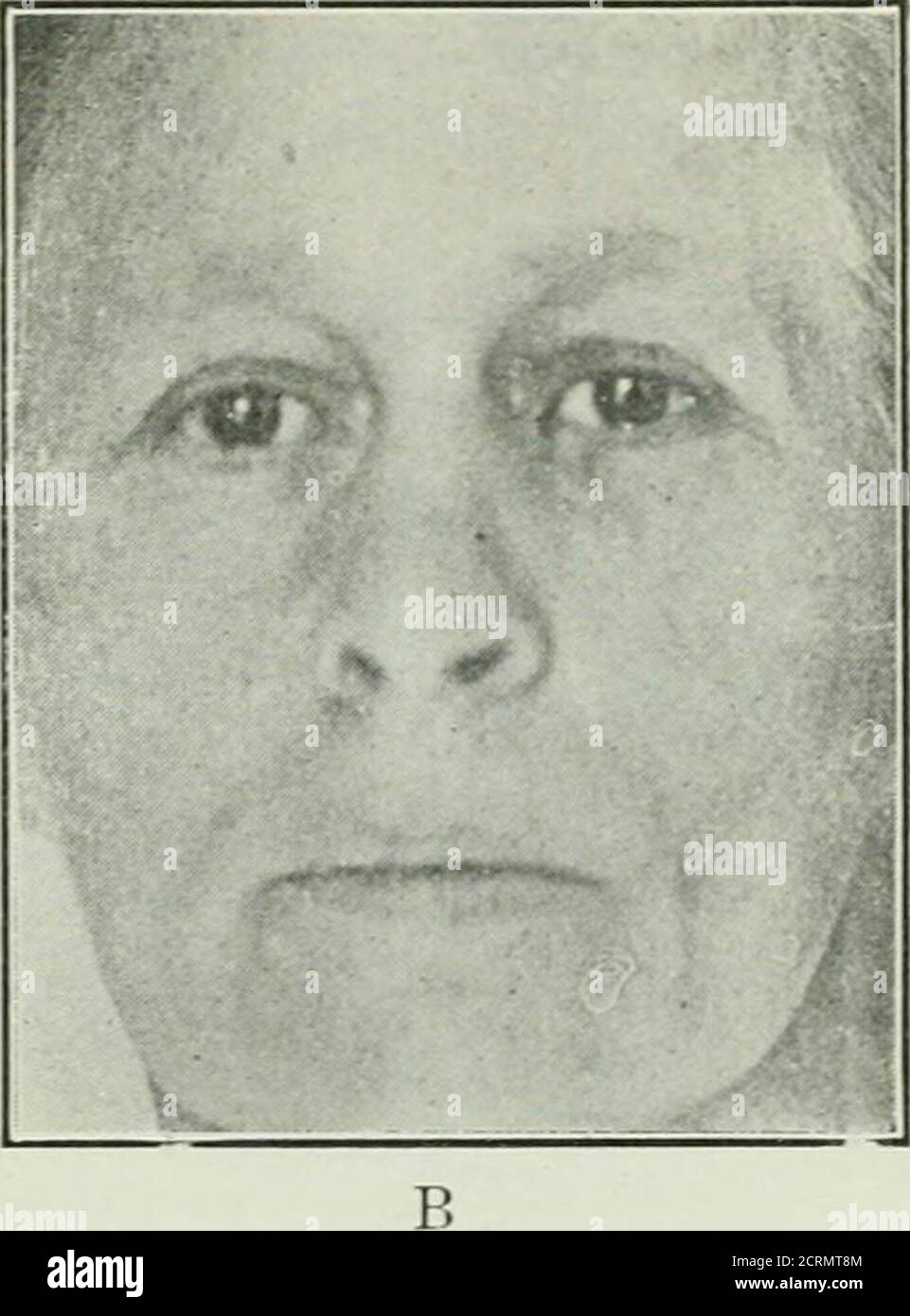 . Radium . Fig. 14.—A. epitlielioma involving the lower eyelid and inner canthus. Referred by Dr. P. M. K. Schwenk. Philadelphia. B. result of one desiccation treatment. Xote good cosmetic result with no contracted cicatrix. Stock Photo